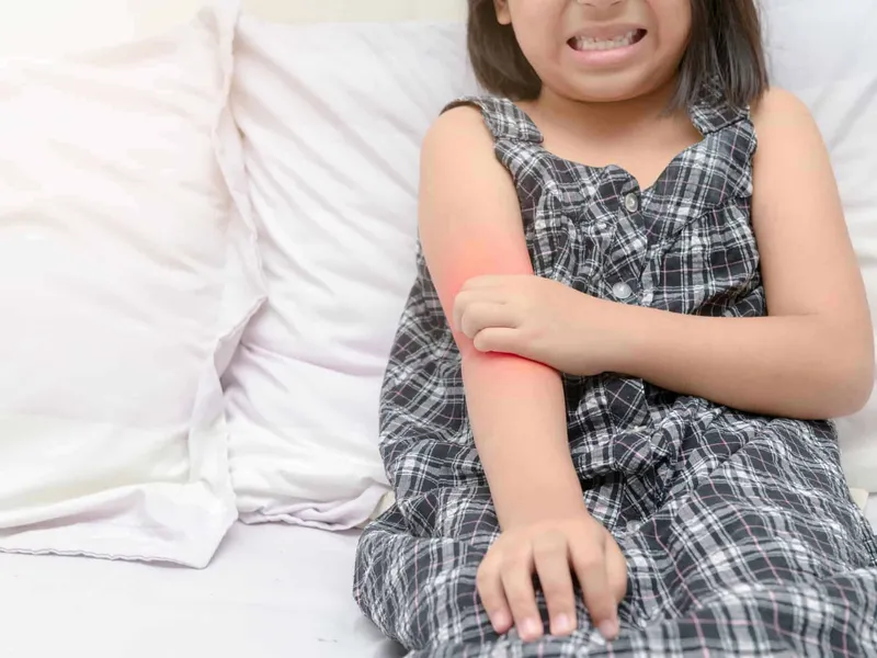Child Psoriasis